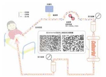 免疫吸附疗法五大特点.jpg 免疫吸附疗法五大特点.jpg
